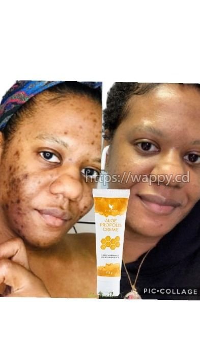 Crème aloé propolis forever/ bouton/ peau sèche -